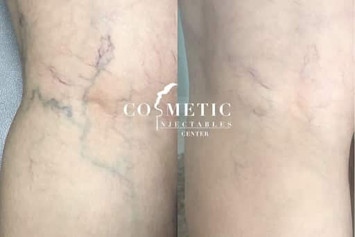 Asclera Vein Injections Sherman Oaks