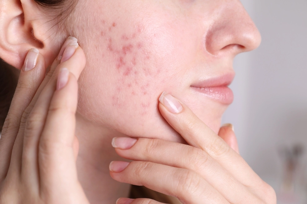 Acne Breakouts: What Your Skin Is Trying To Tell You