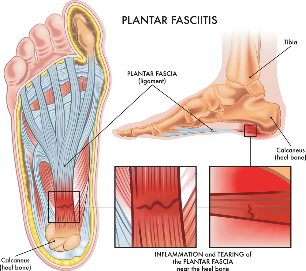 where to inject bpc 157 for plantar fasciitis - Everything You Need Know Injections Around The Ankle and