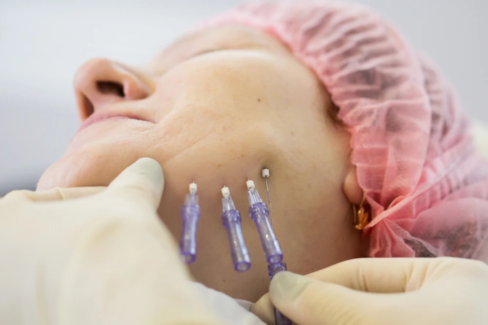 Novathreads-thread-lift-skin-tightening-procedure Close-Up Of A Patient Undergoing A Novathreads Thread Lift Procedure For Skin Tightening And Rejuvenation