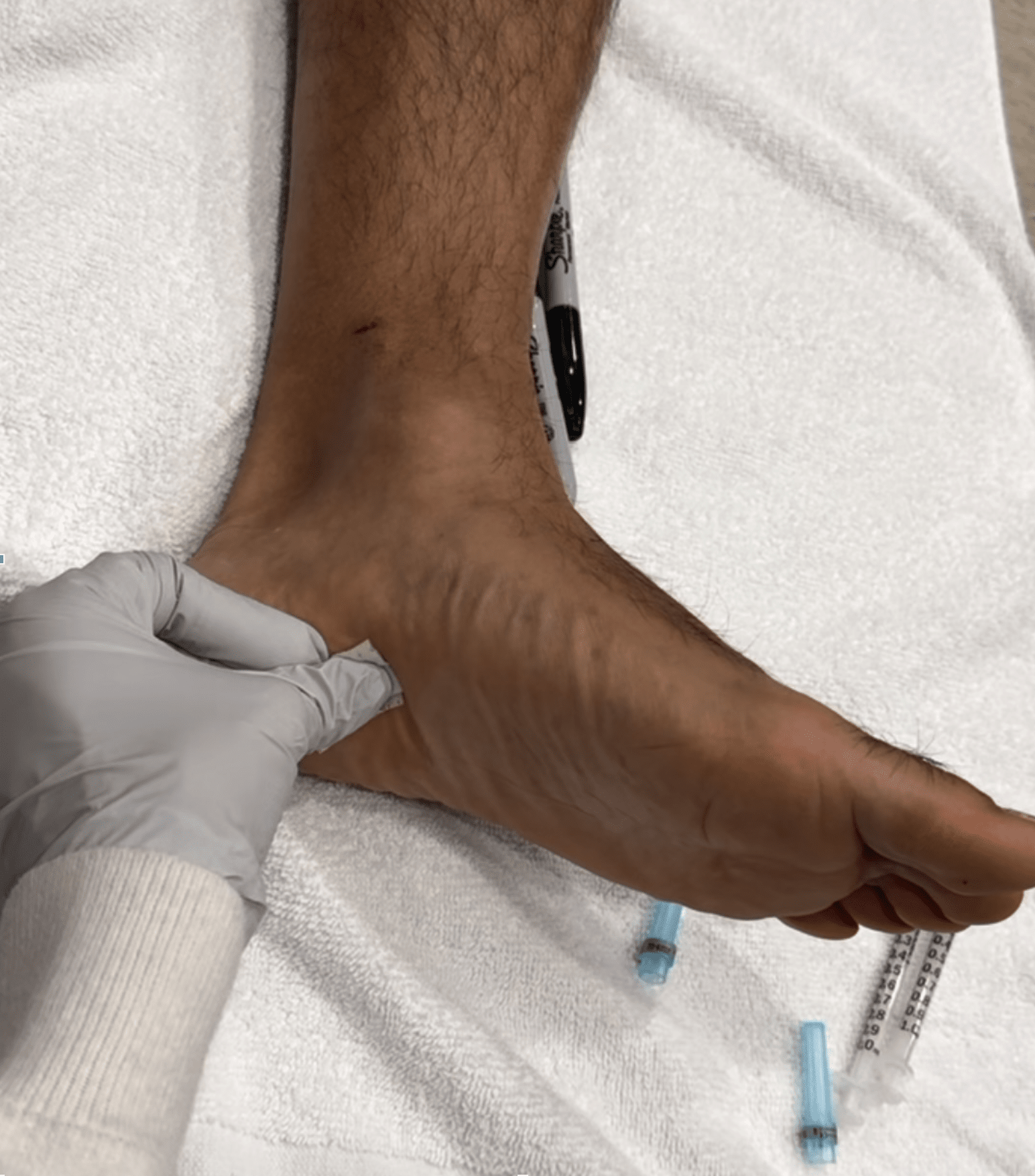 Screenshot 2025-01-31 at 12. 12. 57 pm Injecting Botox For Plantar Fasciitis Inflammation At Cosmetic Injectable Center In Sherman Oaks.