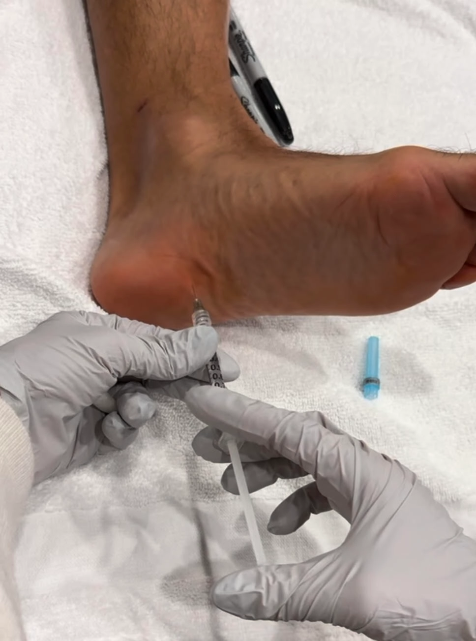 where to inject bpc 157 for plantar fasciitis peptide The most common cause of