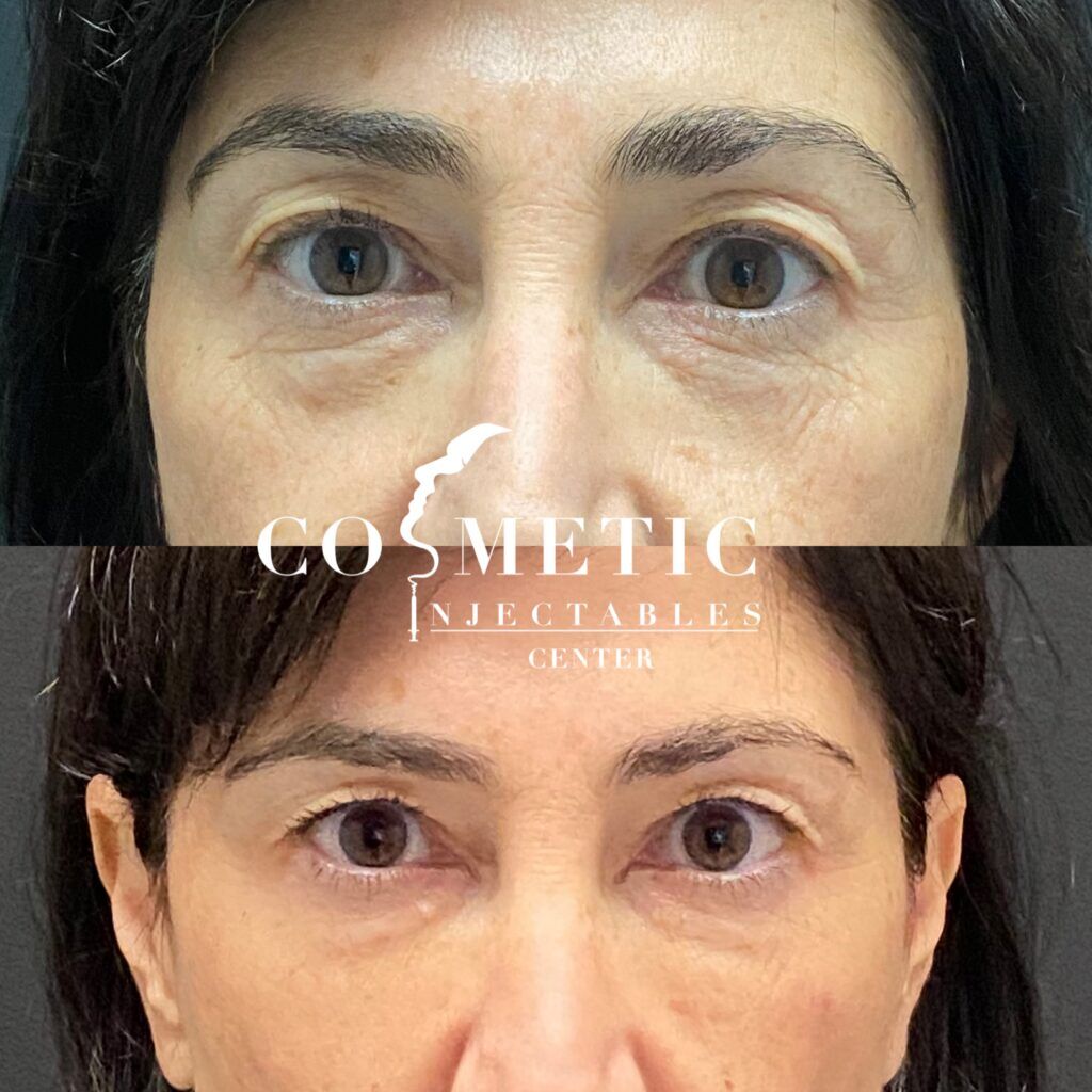 Under-eye hollows vs. Dark circles: what’s really making you look tired? 1 Before And After Cosmetic Undereye Treatment
