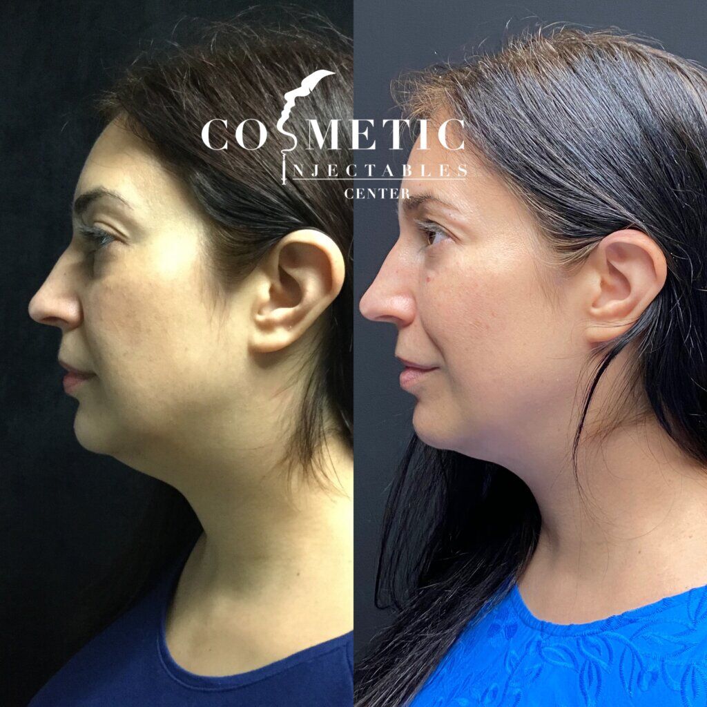 Kybella double chin removal: nonsurgical submental fat reduction 1 Kybella Before After Results Of Patient | Cosmetic Injectables Center Medspa | Sherman Oaks, Los Angeles, Ca