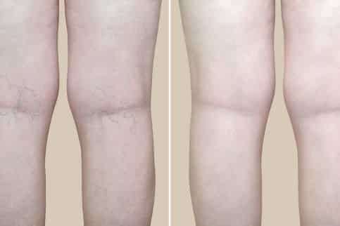 is it possible to gain weight on semaglutide Can You Gain Weight on Wegovy? Weight Loss Plateaus Explained