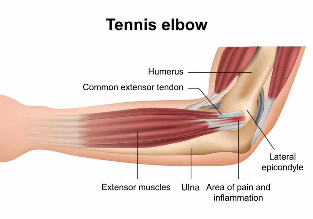 Botox For Tennis Elbow Sherman Oaks