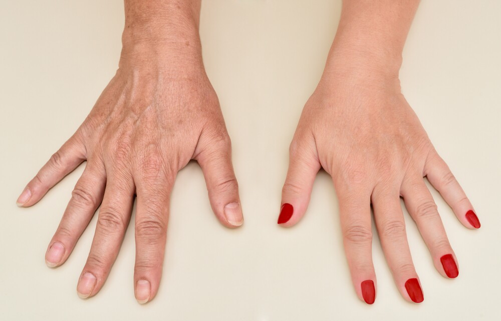 &Quot;Comparison Of Hands Before And After Cosmetic Injectable Procedure At Cosmetic Injectable Centre.