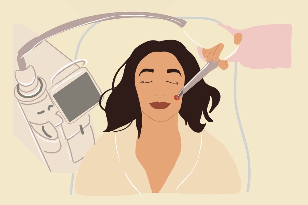 Laser 1 Laser Skin Resurfacing Los Angeles, Ca